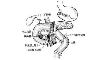 屈氏韧带(又称treitz韧带)解剖位置在横结肠系膜根部,第二腰椎左侧.