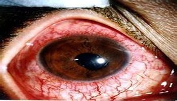急性虹睫炎的症状 睫状充血睫状充血是指位于角膜缘周围的表层巩膜