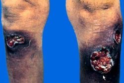 淋病梅毒_360百科