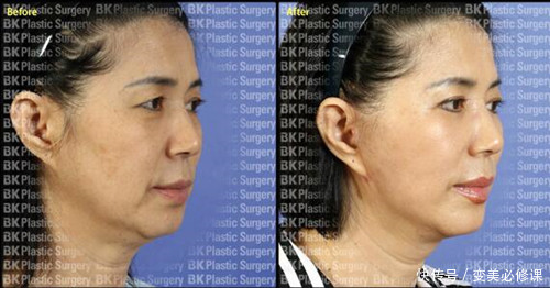 什么是皮秒激光?做一次有效果吗?