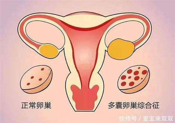 多囊试管婴儿助孕胎停孕是怎么回事,有哪些表