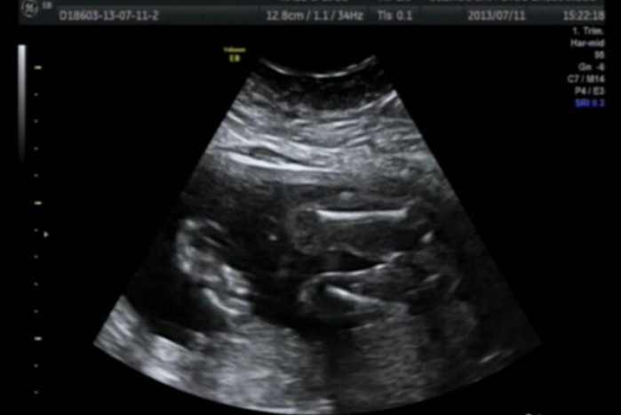 从唐氏筛查、B超、四维彩超可判定胎儿性别,