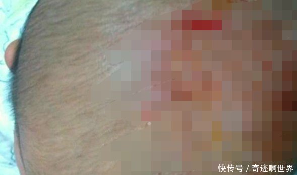 两个月宝宝头上有脏东西,妈妈抠掉了它,却把