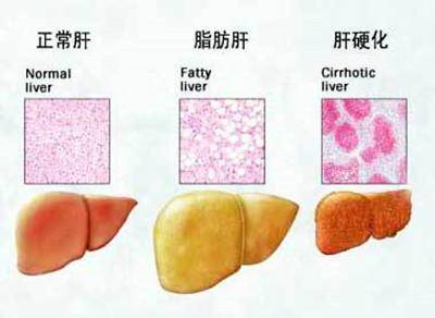 跑步是消除脂肪肝最快的方法，怎么跑才能事半功倍呢?