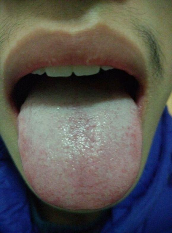 3,看舌苔你渴而不欲饮,气血不足,脾肾阳虚,肝郁血瘀,内心很是纠结焦躁