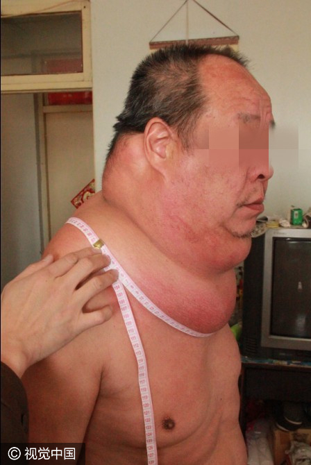 【转】北京时间 53岁男子得怪病 脖子周长97厘米起床困难易摔倒 - 妙康居士 - 妙康居士~晴樵雪读的博客 【转】北京时间 53岁男子得怪病 脖子周长97厘米起床困难易摔倒 - 妙康居士 - 妙康居士~晴樵雪读的博客