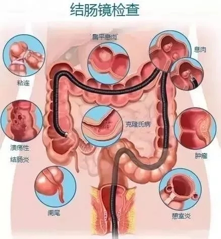 超全讲解:胃镜、肠镜、胶囊内镜