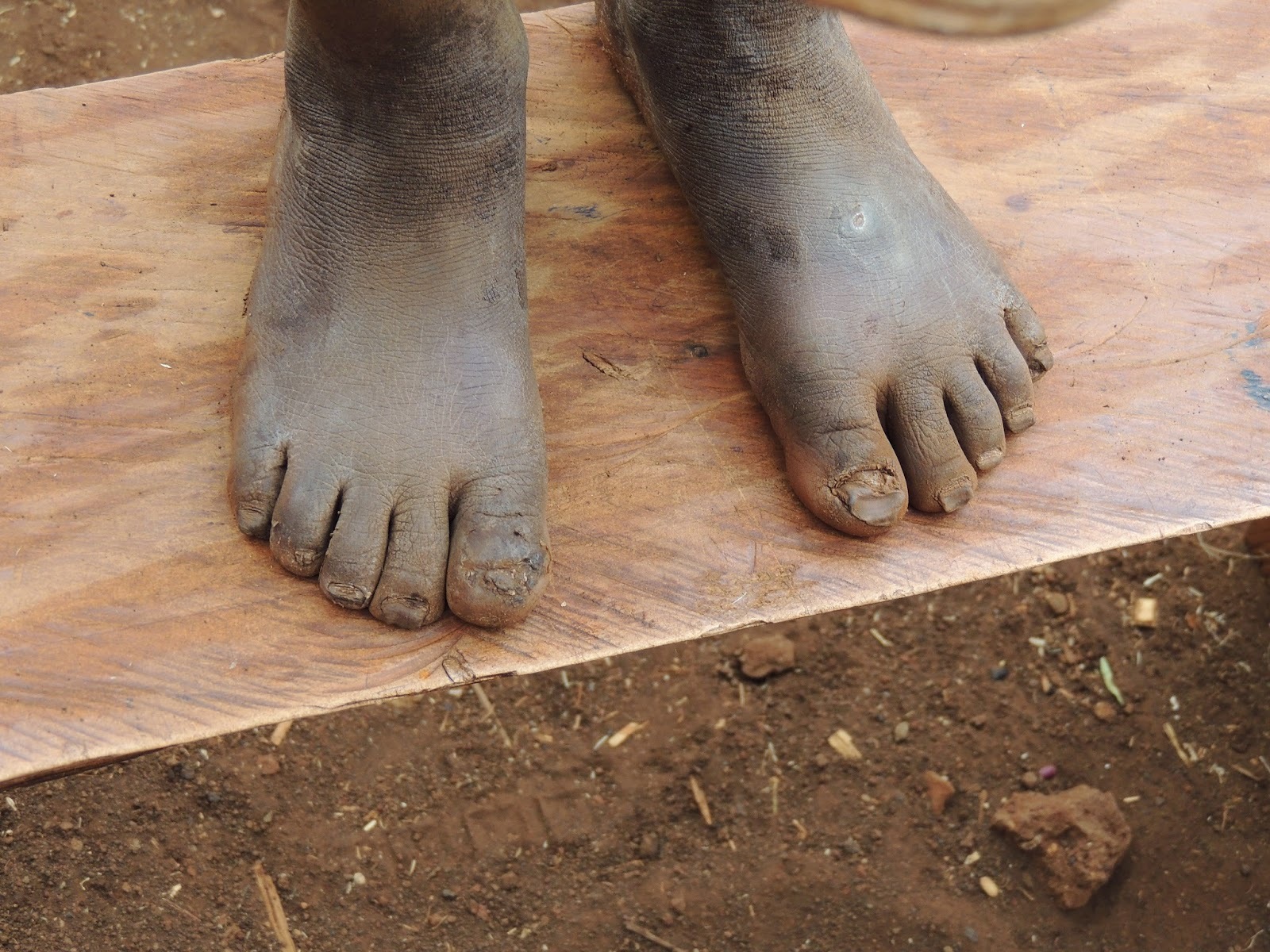 实拍非洲"烂脚病",脚板千疮百孔只因没鞋穿 看上去非常恶心