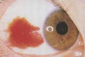的孩子眼睛里先是红血丝后来变成很大的红点块