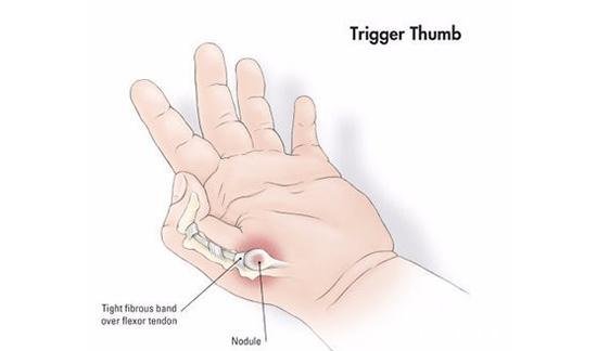 大拇指腱鞘炎几个治疗偏方