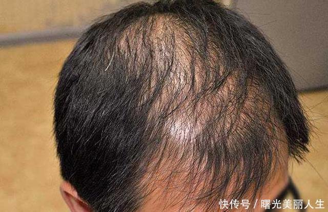 头发种植一般多少钱 头发种植的注意事项