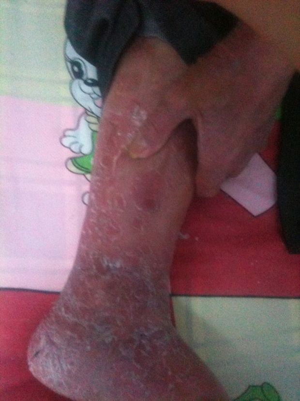 吃完海鲜过敏怎么办_儿童海鲜过敏症状_海鲜过敏痒怎么办
