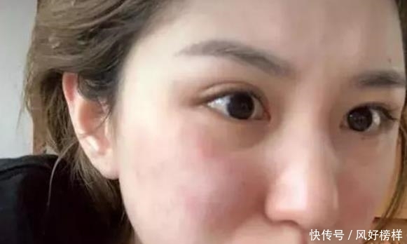 如何消灭痘痘痘印?“标杆级”的祛痘膏,轻松解决痘痘无痘印 龙8国际娱乐手机登录