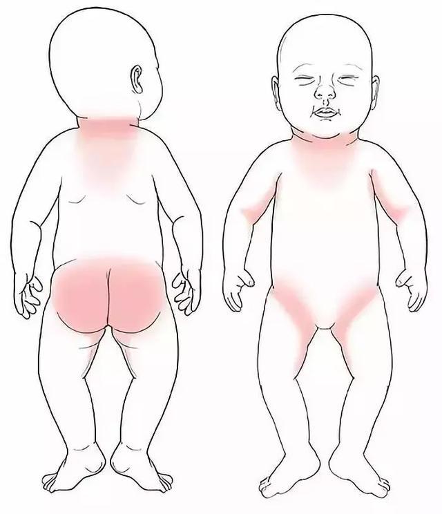 一文教你分辨宝宝常见疹子:湿疹和痱子