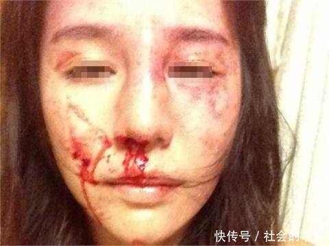 女人去医院取避孕环,却被揭出家暴事实,医生报警