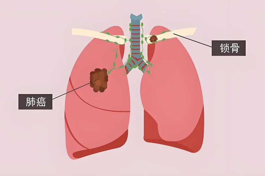 37岁女子从确诊肺癌到去世仅2周。肺癌的早期症状有哪些？