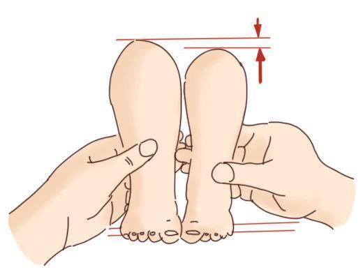 宝宝走路不稳、腿纹不对称, 家长要警惕是髋关