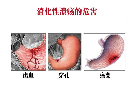 胃溃疡发生癌变会有征兆吗?