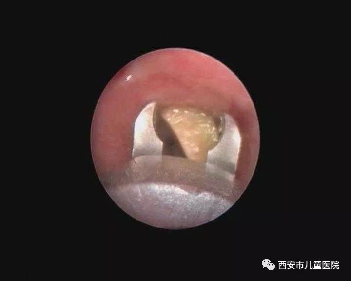 春节西安儿童医院接诊21例气管异物 紧急时这