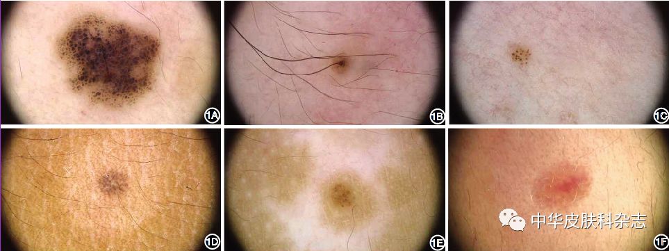 影响晕痣疗效的因素有哪些?