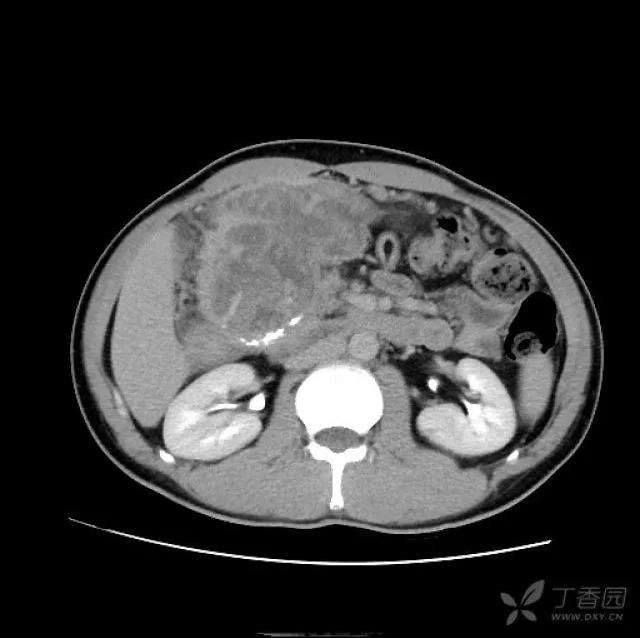 右上腹这个肿块，做出精准诊断真的很难!