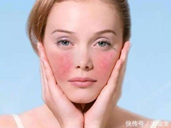 激素脸一直泛红起皮涂什么都过敏怎么办,过敏