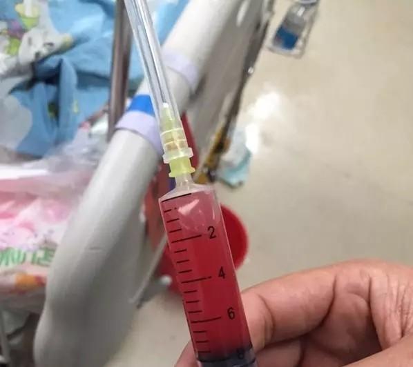 打开小云的腹腔,医生抽出很多血性腹水