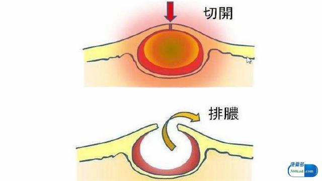 耳朵后面长了个硬包是咋回事?医生:要警惕这几种问题