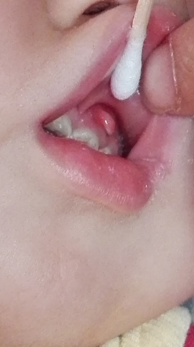 儿童牙龈 怎么治