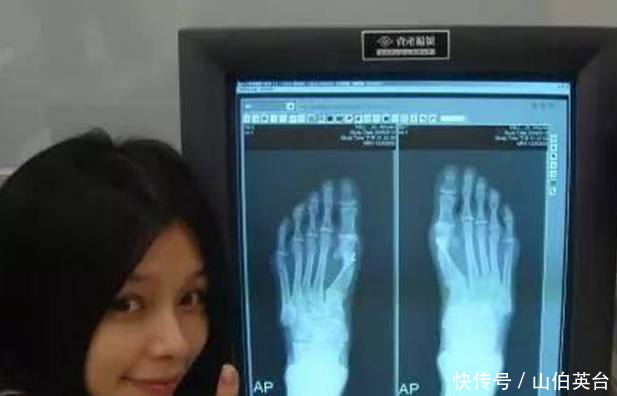 女星的脚好可怕!王子文最苦命,徐若瑄动手术,赵