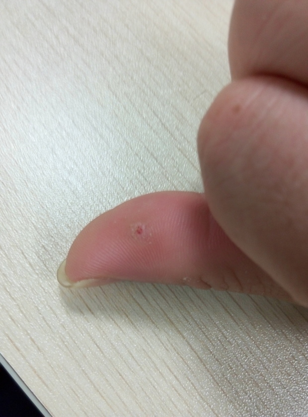 大拇指长了个硬疙瘩割开后里面有几条红色的