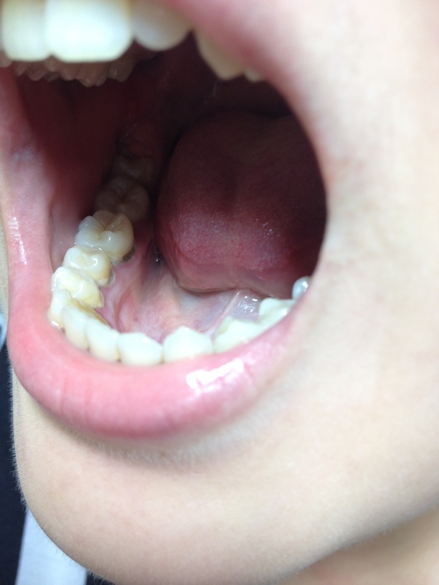 牙齿里面板牙有的是什么原因