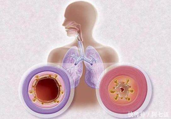 慢性支气管炎痰量多,怎么祛痰和止咳?你值得试