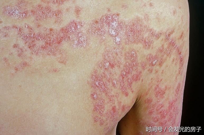 牛皮癣(银屑病)详细分类,患牛皮癣的可以详细看看