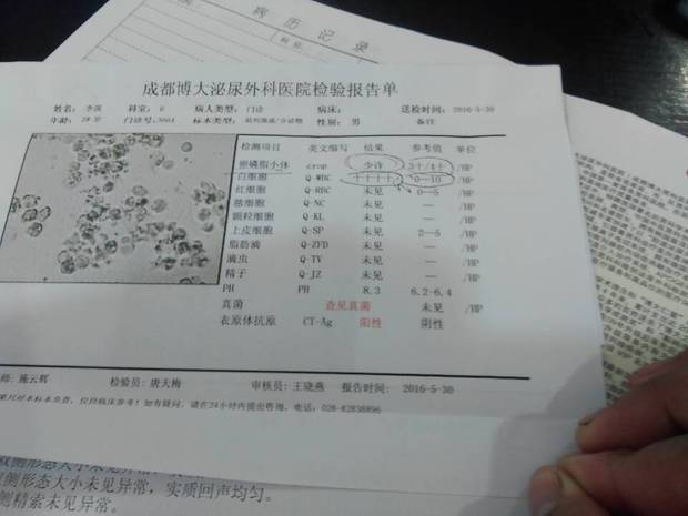 前列腺液检查报告单卵磷脂小体结果少许白细胞    真菌查见真菌这种