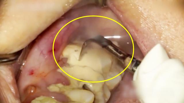 模拟洗牙,看牙齿上又黄又硬的牙结石是怎么样