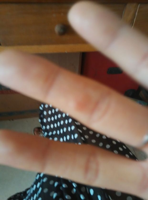 胳膊上起疙瘩很痒 _小孩背部痒有小疙瘩_腿上