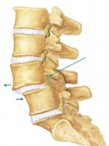 腰椎间盘滑脱