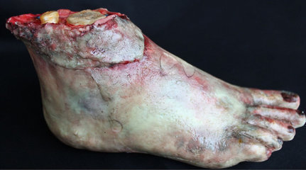 脚上起包，脚上很痒，冒黄水，很疼，肿胀。。。有硬块物质，小包…痒!越挠越大~慢慢的肿起来了… 金牛网