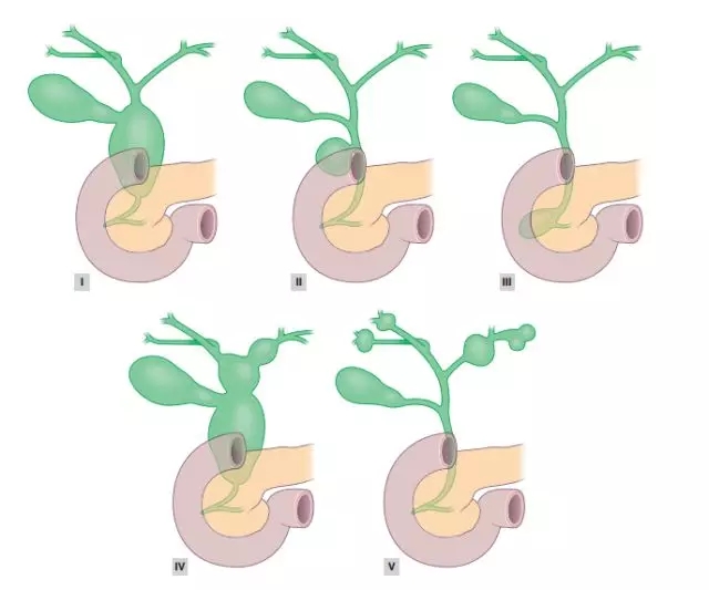 癌前病变 | 胆总管畸形怎么办，看这篇综述就够了