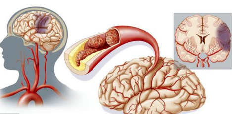 脑血管堵塞时,身体会慢慢出现5个明显特征!及