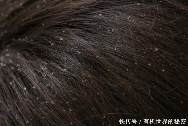 洗头后,拨开头发一看密密麻麻全是头皮屑,2招教你轻松去除它!