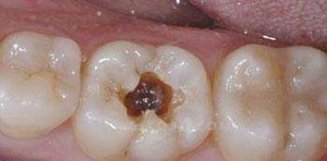 蛀牙引起的牙神经痛怎么进行简单处