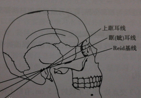 听眦线的英文缩写到底是ABL还是RBL