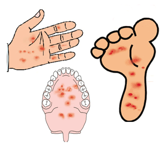 六月潜伏着手足口病这个大魔王,年轻爸妈们要