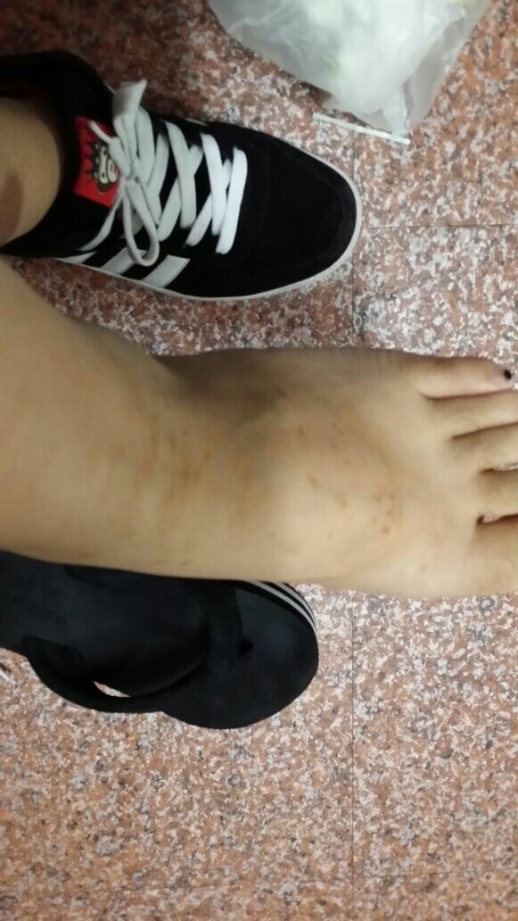 两只脚的脚背都起了大大小小的褐色斑点块儿,是什么病