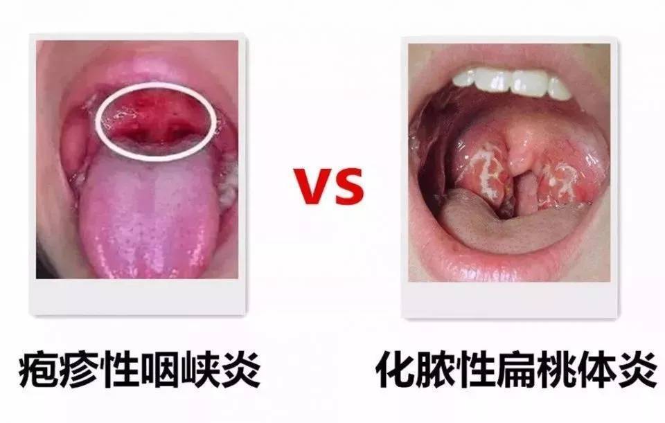 家长们注意了!孩子得了化脓性扁桃体炎怎么办