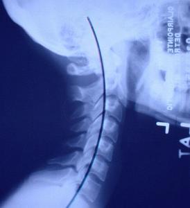 CT检査发现左侧颈椎(C6水平)脊髓损伤,请推断