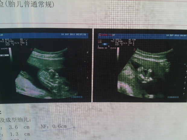 怀孕四个月胎儿骨发育不全(附图)
