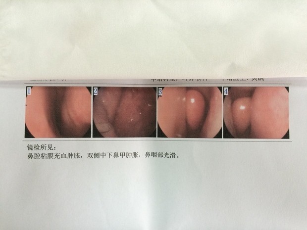 鼻腔粘膜充血肿胀,双侧中下鼻甲肿胀,鼻咽部光滑.诊断